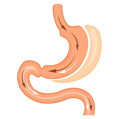 Image of vertical gastric sleeve